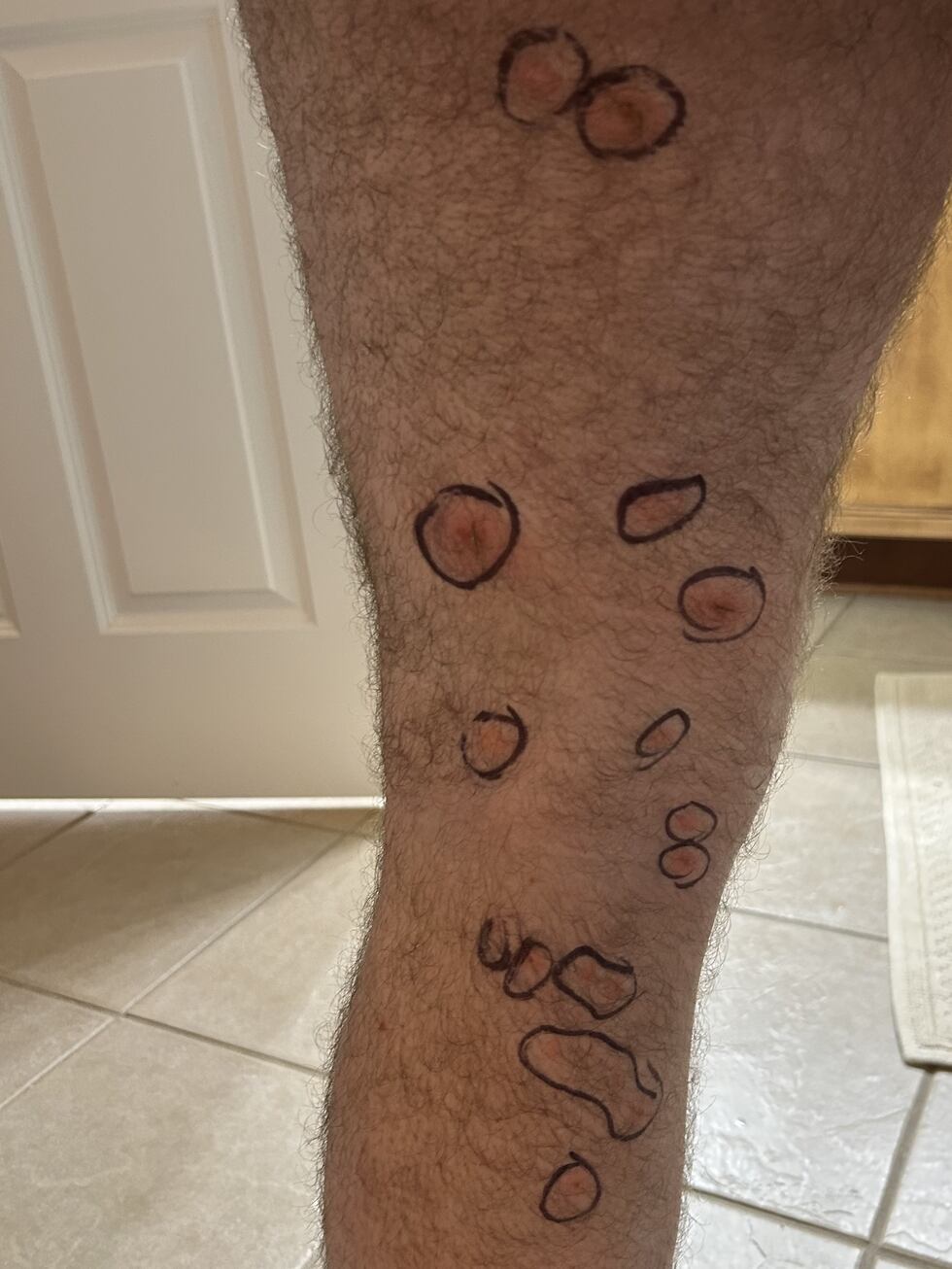 A man said some of his dozens of bedbug bites got infected.